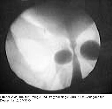 Harninkontinenz - Mann - Chirurgie