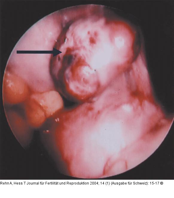Leiomyomatse Omentum majus-Neoplasie