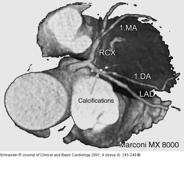 Koronarangiographie - Multislice CT