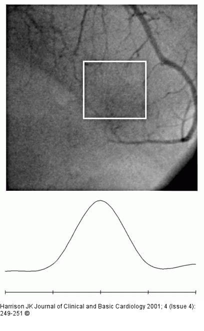 R. interventricularis anterior - Stenose