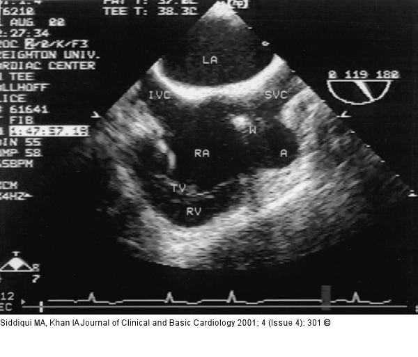 Rechtsatrialer Appendix