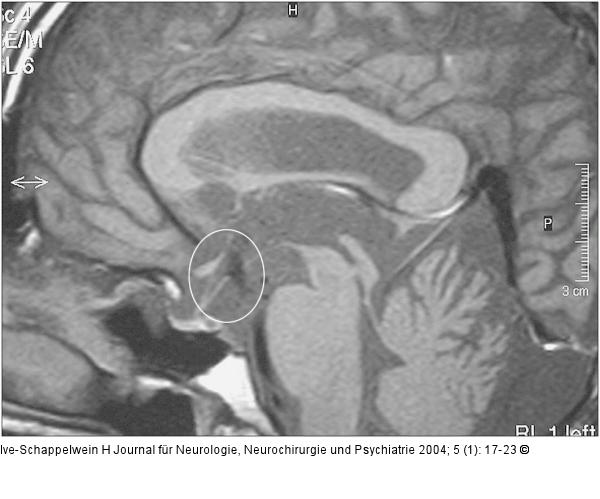 Hydrozephalus beim Erwachsenen