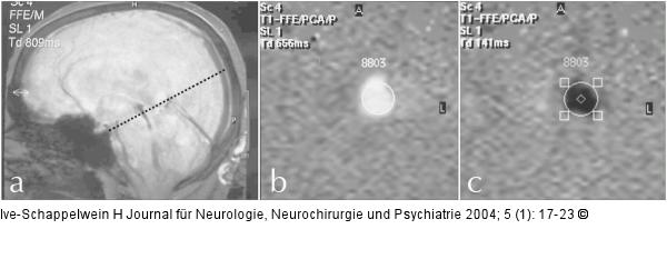 Hydrozephalus beim Erwachsenen