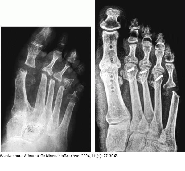 Rheumatoide Arthritis