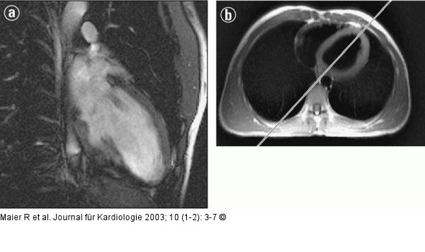 Kardiale Magnetresonanztomographie