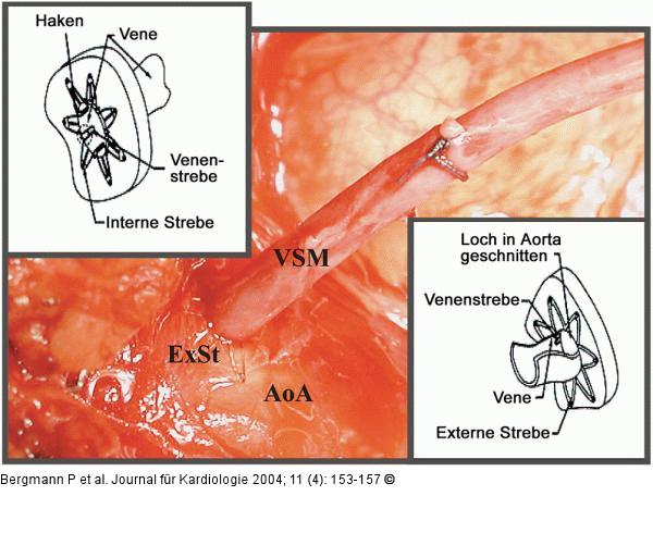 Anastomosendevices