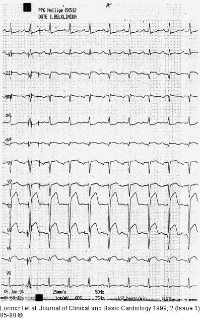 QT-Dispersion nach Thrombolyse