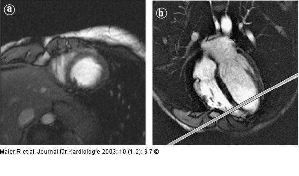 Kardiale Magnetresonanztomographie