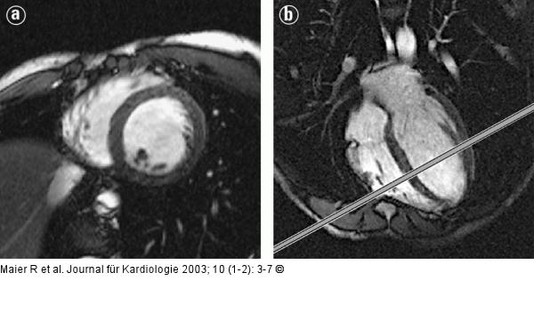 Kardiale Magnetresonanztomographie