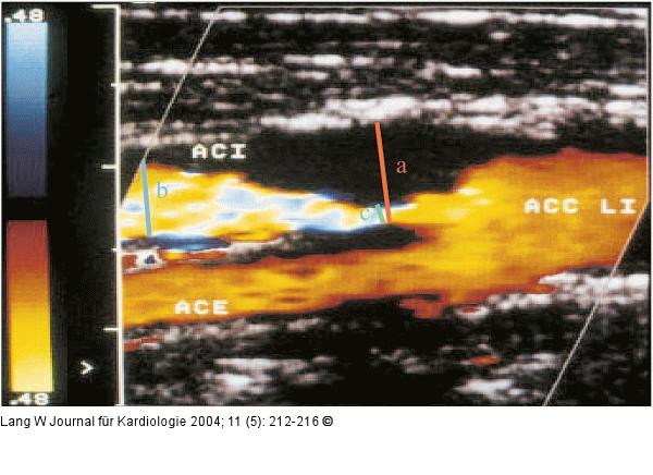 Duplexsonographie zur Berechnung des Stenosegrades