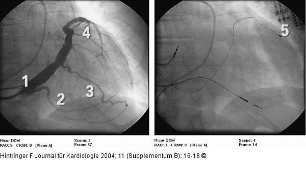 Biventrikulre Schrittmachertherapie - Sinus coronarius-Venogramm