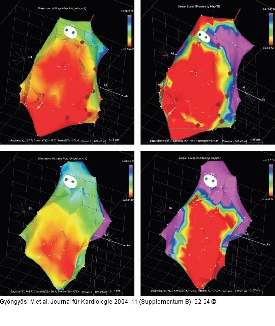 NOGA-Mapping - Stammzellinjektionstherapie