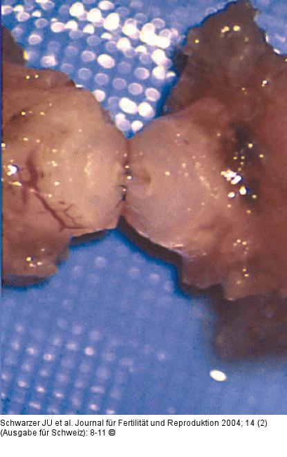 Vasovasostomie - Duktusstmpfe