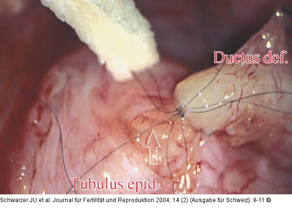 Tubulovasostomie - Mukosa - Muscularis - Serosa
