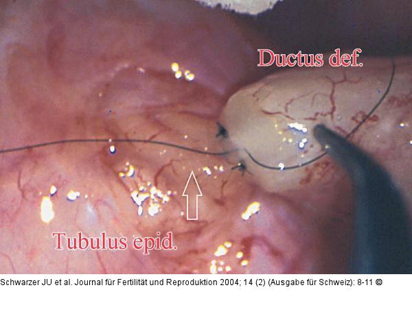 Tubulovasostomie - Mukosa - Tubulus