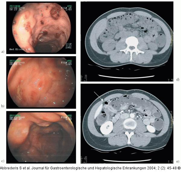 Pneumotosis cystoides intestinalis