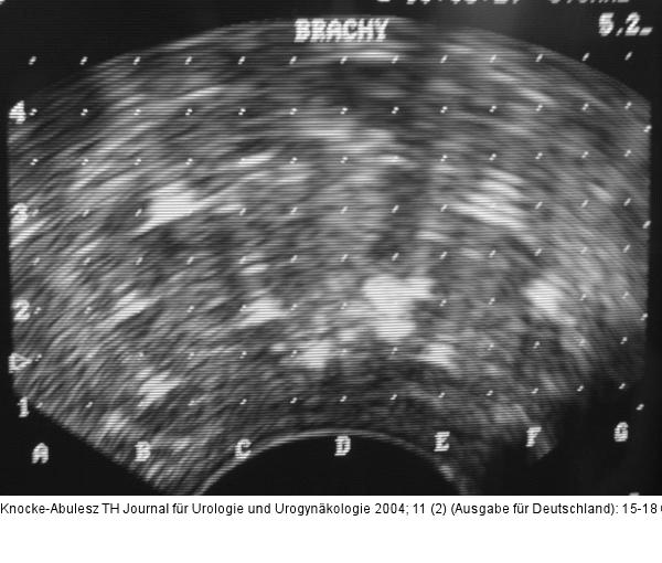 Prostatakarzinom - HDR-Brachytherapie