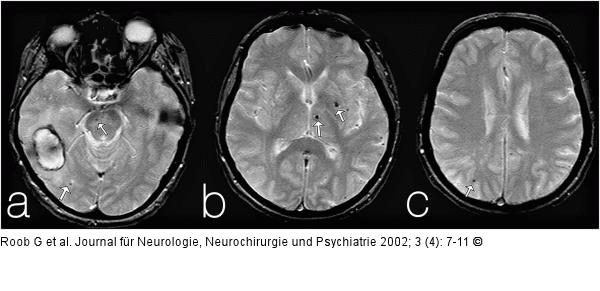 Intrazerebrale Blutung