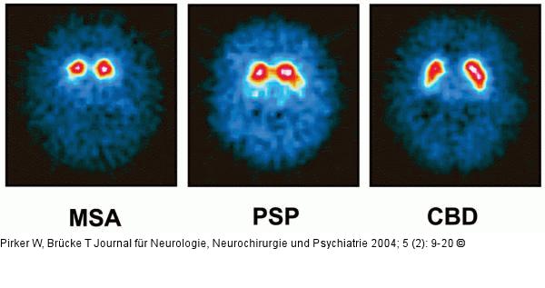 Morbus Parkinson - SPECT