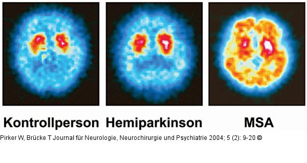 Morbus Parkinson - SPECT