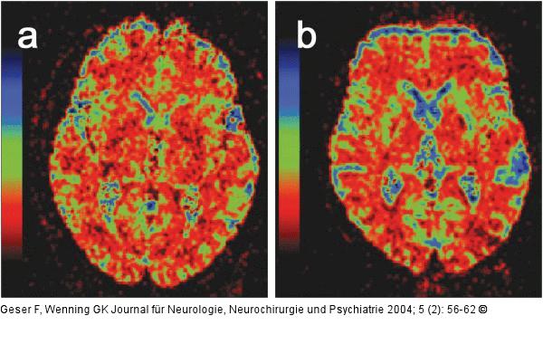 MSA - Diffusion weighted imaging