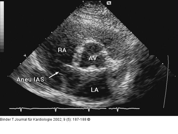 Interatriales Septum - Aneurysma