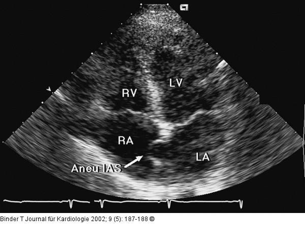 Interatriales Septum - Aneurysma