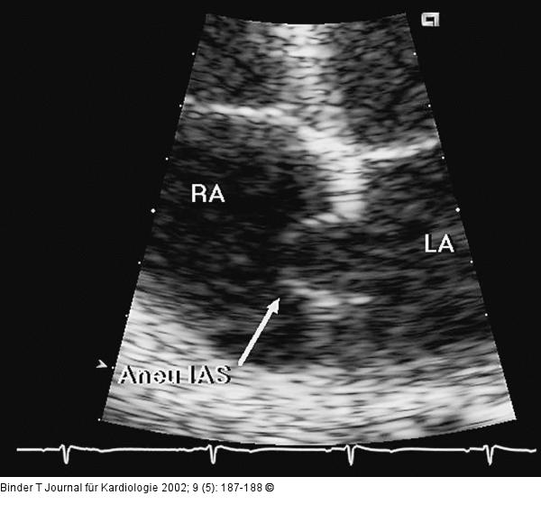 Interatriales Septum - Aneurysma
