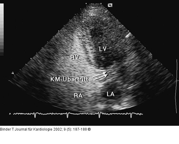 Interatriales Septum - Aneurysma
