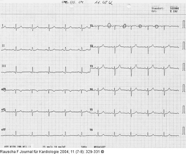 Sinusrhythmus mit zustzlicher Vorhoferregung