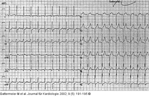 Subakute Stentthrombose - Fallbericht