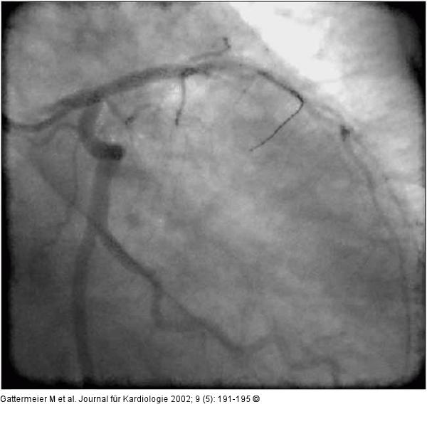 Subakute Stentthrombose - Fallbericht