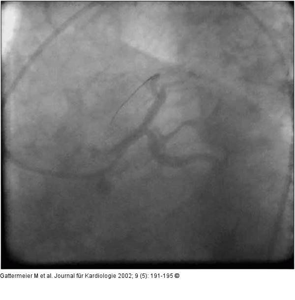 Subakute Stentthrombose - Fallbericht