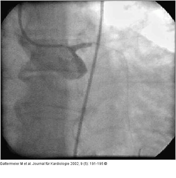Subakute Stentthrombose - Fallbericht