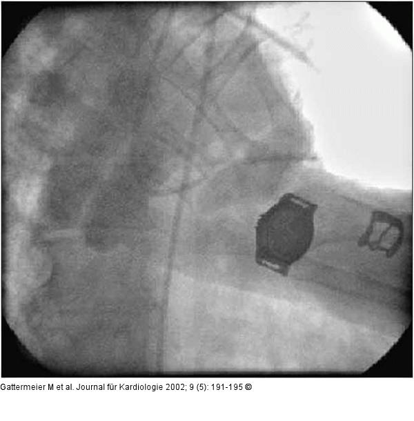 Subakute Stentthrombose - Fallbericht