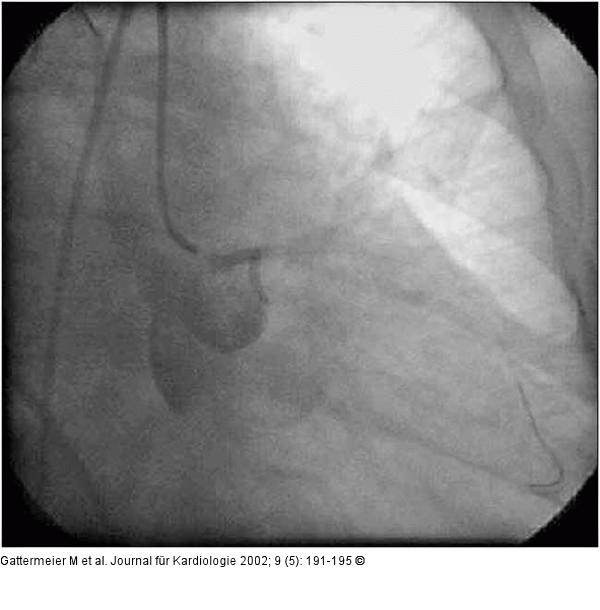 Subakute Stentthrombose - Fallbericht