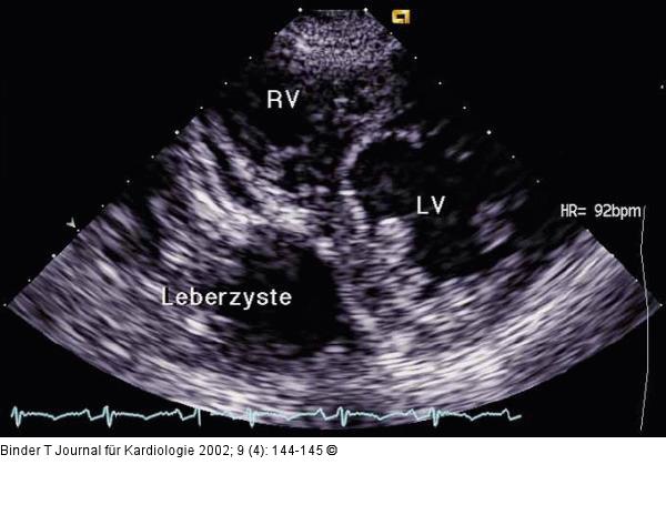 Polyzystische Nephropathie
