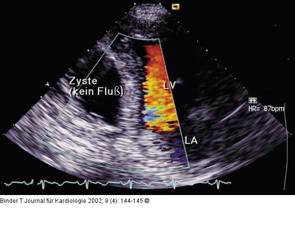 Polyzystische Nephropathie