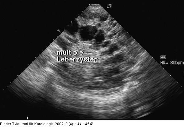 Polyzystische Nephropathie