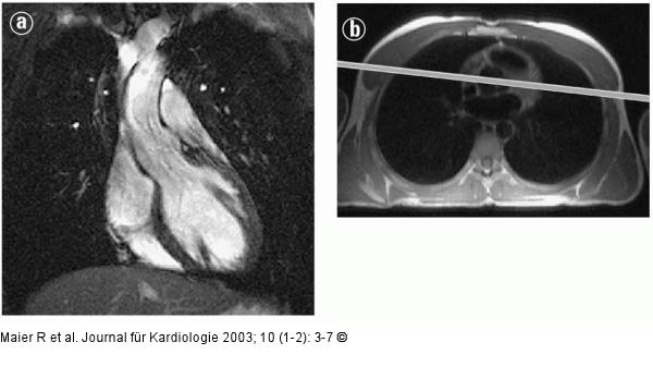 Kardiale Magnetresonanztomographie
