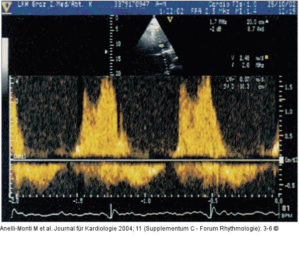 HF-Ablation - Transmitrales Flumuster