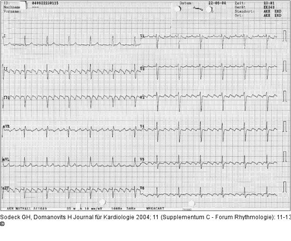 EKG - Beschwerdefreiheit