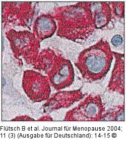 Stanzbiopsie - Karzinomgewebe