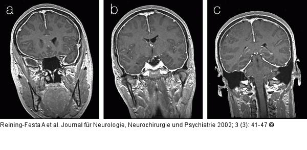 Hypertrophe chronische Pachymeningitis