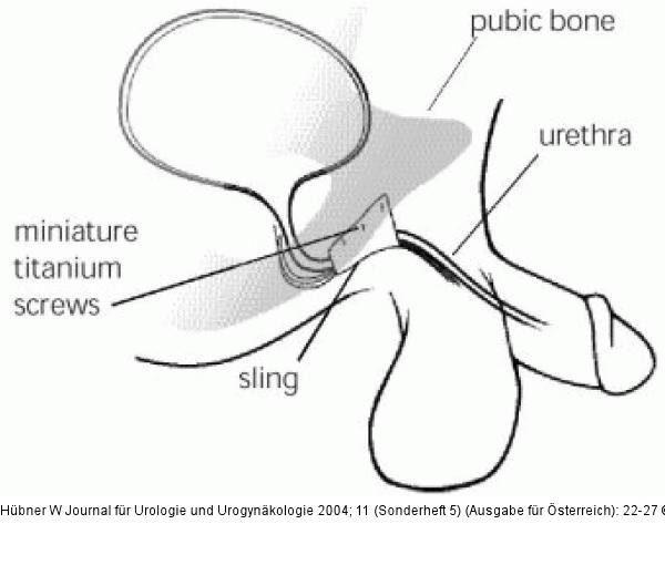 In-Vance-System