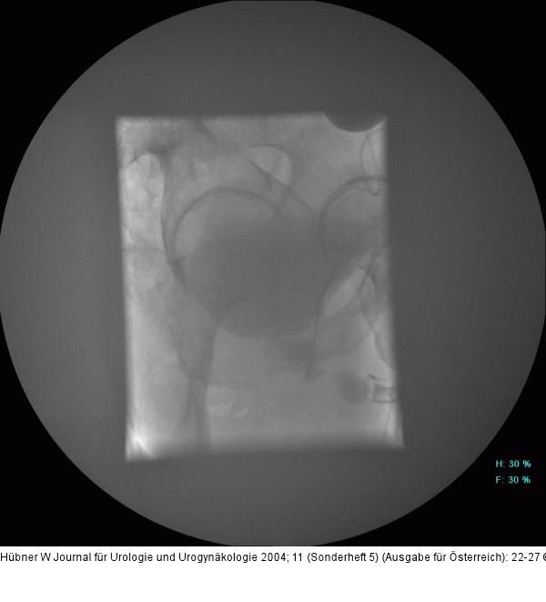 Scott-Spinkter-Implantation - Insuffizienter Blasenhals