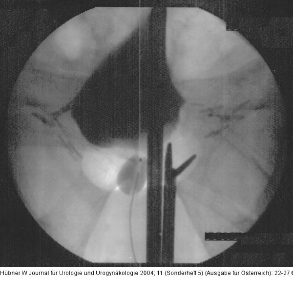 Pro-ACT-Technik - Dilatationsbesteck