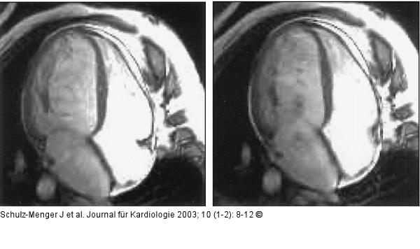 Kardiale Magnetresonanztomographie