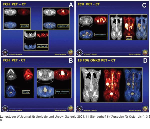 18F-Cholin-PET-CT