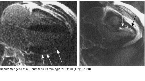 Kardiale Magnetresonanztomographie